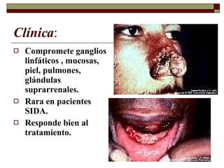 Clínica : Compromete ganglios linfáticos , mucosas, piel, pulmones, glándulas suprarrenales. Rara en pacientes SIDA. Responde bien al tratamiento. 
