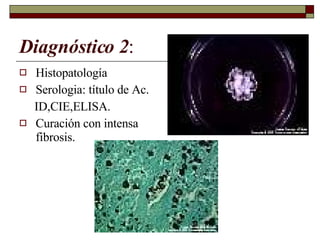 Diagnóstico 2 : Histopatología Serologia: título de Ac. ID,CIE,ELISA. Curación con intensa fibrosis. 
