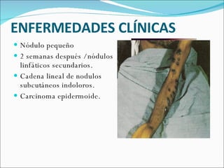 ENFERMEDADES CLÍNICAS  Nódulo pequeño 2 semanas después / nódulos linfáticos secundarios.  Cadena lineal de nodulos subcutáneos indoloros. Carcinoma epidermoide.  