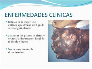 ENFERMEDADES CLINICAS  fístulas en la superficie cutánea que drenan un líquido serosanguinolento.  atravesar los planos tisulares y origina la destrucción local de músculo y hueso. No es muy común la diseminación  