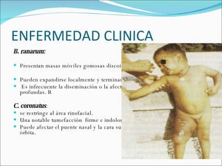 ENFERMEDAD CLINICA B. ranarum:  Presentan masas móviles gomosas discoides).  Pueden expandirse localmente y terminar por ulcerarse. Es infrecuente la diseminación o la afectación de otras estructuras más profundas. R C. coronatus :  se restringe al área rinofacial.  Una notable tumefacción  firme e indolora del labio superior o la cara  Puede afectar el puente nasal y la cara superior e inferior, incluyendo la órbita.  