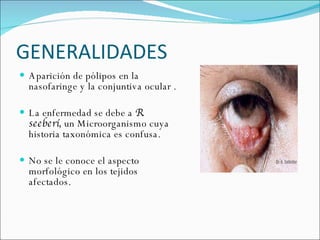 GENERALIDADES  Aparición de pólipos en la nasofaringe y la conjuntiva ocular .  La enfermedad se debe a  R. seeberí,  un Microorganismo cuya historia taxonómica es confusa. No se le conoce el aspecto morfológico en los tejidos afectados.  