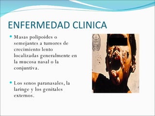 ENFERMEDAD CLINICA  Masas polipoides o semejantes a tumores de crecimiento lento localizadas generalmente en la mucosa nasal o la conjuntiva. Los senos paranasales, la laringe y los genitales externos.  