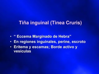 Tiña inguinal (Tinea Cruris) “  Eccema Marginado de Hebra” En regiones inguinales, perine, escroto Eritema y escamas; Borde activo y vesículas 