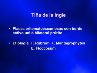 Tiña de la ingle Placas eritematoescamosas con borde activo uni o bilateral prúrito Etiología. T. Rubrum, T. Mentagrophytes E. Floccosum 