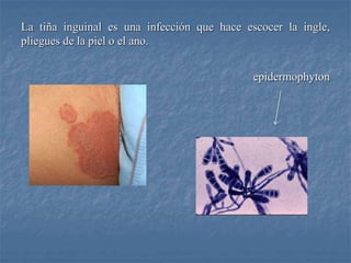 La tiña inguinal es una infección que hace escocer la ingle,
pliegues de la piel o el ano.
epidermophyton
 