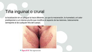 Tiña inguinal o crural
la localización en un pliegue la hace diferente, ya que la maceración, la humedad y el calor
predisponen a un intenso prurito que modifica el aspecto de las lesiones, básicamente
semejante al de cualquier tiña del cuerpo.
 