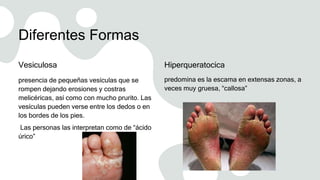 Diferentes Formas
Vesiculosa
presencia de pequeñas vesículas que se
rompen dejando erosiones y costras
melicéricas, así como con mucho prurito. Las
vesículas pueden verse entre los dedos o en
los bordes de los pies.
Las personas las interpretan como de “ácido
úrico”
Hiperqueratocica
predomina es la escama en extensas zonas, a
veces muy gruesa, “callosa”
 