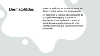 Dermatofitides brotes de vesículas en las manos, entre los
dedos o en las palmas con intenso prurito.
En ocasiones la vesícula apenas levanta de
la superficie de la piel y lo que se ve
después es el resultado de su ruptura en
forma de una pequeña escama de unos
cuantos milímetros que cubre una depresión
puntiforme.
 