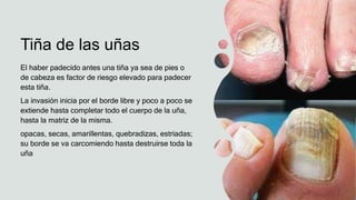 Tiña de las uñas
El haber padecido antes una tiña ya sea de pies o
de cabeza es factor de riesgo elevado para padecer
esta tiña.
La invasión inicia por el borde libre y poco a poco se
extiende hasta completar todo el cuerpo de la uña,
hasta la matriz de la misma.
opacas, secas, amarillentas, quebradizas, estriadas;
su borde se va carcomiendo hasta destruirse toda la
uña
 