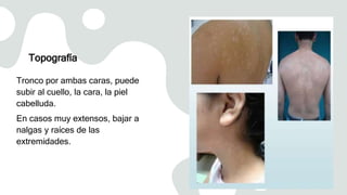 Topografía
Tronco por ambas caras, puede
subir al cuello, la cara, la piel
cabelluda.
En casos muy extensos, bajar a
nalgas y raíces de las
extremidades.
 