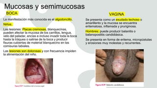 Mucosas y semimucosas
BOCA
La manifestación más conocida es el algodoncillo.
Niños.
Las lesiones: Placas cremosas, blanquecinas,
pueden afectar la mucosa de los carrillos, lengua,
velo del paladar, encías e incluso invadir toda la boca
hasta la tráquea o salirse de la boca y producir
fisuras cubiertas de material blanquecino en las
comisuras labiales.
Las lesiones son dolorosas y con frecuencia impiden
la alimentación del niño.
VAGINA
Se presenta como un exudado lechoso o
amarillento y la mucosa se encuentra
eritematosa, inflamada y pruriginosa.
Hombres: puede producir balanitis o
balanopostitis candidiásica.
Se presenta en forma de eritema, micropústulas
y erosiones muy molestas y recurrentes.
 