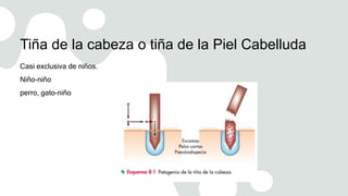 Tiña de la cabeza o tiña de la Piel Cabelluda
Casi exclusiva de niños.
Niño-niño
perro, gato-niño
 