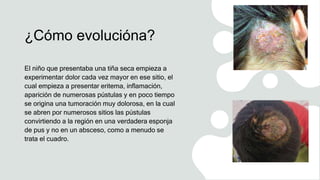 ¿Cómo evolucióna?
El niño que presentaba una tiña seca empieza a
experimentar dolor cada vez mayor en ese sitio, el
cual empieza a presentar eritema, inflamación,
aparición de numerosas pústulas y en poco tiempo
se origina una tumoración muy dolorosa, en la cual
se abren por numerosos sitios las pústulas
convirtiendo a la región en una verdadera esponja
de pus y no en un absceso, como a menudo se
trata el cuadro.
 