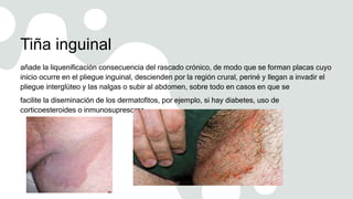 Tiña inguinal
añade la liquenificación consecuencia del rascado crónico, de modo que se forman placas cuyo
inicio ocurre en el pliegue inguinal, descienden por la región crural, periné y llegan a invadir el
pliegue interglúteo y las nalgas o subir al abdomen, sobre todo en casos en que se
facilite la diseminación de los dermatofitos, por ejemplo, si hay diabetes, uso de
corticoesteroides o inmunosupresores.
 