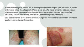 A menudo el hongo es llevado por el mismo paciente desde los pies y se desarrolla la colonia
en la misma forma descrita para la tiña de la piel lampiña, hasta formar las clásicas placas
eritematosas con escamas y liquenificación y con borde activo, también con pequeñas
vesículas y costras hemáticas y melicéricas (eccema marginado de Hebra).
Esta localización de la tiña es más crónica, pruriginosa y resistente al tratamiento, además de
que las recurrencias son frecuentes.
 