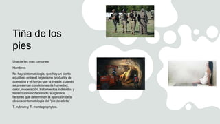 Tiña de los
pies
Una de las mas comunes
Hombres
No hay sintomatología, que hay un cierto
equilibrio entre el organismo productor de
queratina y el hongo que la invade, cuando
se presentan condiciones de humedad,
calor, maceración, tratamientos indebidos y
terreno inmunodeprimido, surgen los
factores que determinan la aparición de la
clásica sintomatología del “pie de atleta”
T. rubrum y T. mentagrophytes.
 