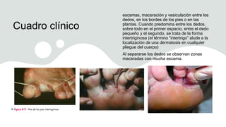 Cuadro clínico
escamas, maceración y vesiculación entre los
dedos, en los bordes de los pies o en las
plantas. Cuando predomina entre los dedos,
sobre todo en el primer espacio, entre el dedo
pequeño y el segundo, se trata de la forma
intertriginosa (el término “intertrigo” alude a la
localización de una dermatosis en cualquier
pliegue del cuerpo)
Al separarse los dedos se observan zonas
maceradas con mucha escama.
 