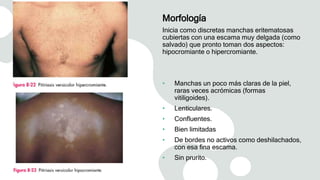 Morfología
Inicia como discretas manchas eritematosas
cubiertas con una escama muy delgada (como
salvado) que pronto toman dos aspectos:
hipocromiante o hipercromiante.
• Manchas un poco más claras de la piel,
raras veces acrómicas (formas
vitiligoides).
• Lenticulares.
• Confluentes.
• Bien limitadas
• De bordes no activos como deshilachados,
con esa fina escama.
• Sin prurito.
 