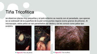 Tiña Tricofitica
se observan placas muy pequeñas y el pelo enfermo se mezcla con el parasitado, que apenas
se ve sobresalir de la superficie de la piel como puntos negros (como granos de pólvora). Al
microscopio, estos pelos se ven parasitados por dentro y se les conoce como pelos tipo
endótrix
 