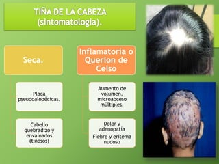 Seca. 
Placa 
pseudoalopécicas. 
Cabello 
quebradizo y 
envainados 
(tiñosos) 
Inflamatoria o 
Querion de 
Celso 
Aumento de 
volumen, 
microabceso 
múltiples. 
Dolor y 
adenopatía 
Fiebre y eritema 
nudoso 
 