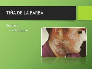 TIÑA DE LA BARBA 
Etiología: 
• T. verrucosum 
 