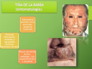 Pústulas 
foliculares, 
aisladas o 
agrupadas 
crónicas, 
abscesos con pus 
Adenopatía 
satélite retro 
auricular, 
alopecia 
cicatrizal 
Placas de borde 
activo, 
redondas, con 
liquenificación 
y escamas 
 