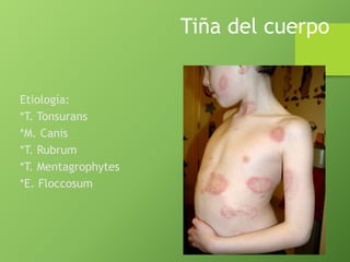 Tiña del cuerpo 
Etiología: 
*T. Tonsurans 
*M. Canis 
*T. Rubrum 
*T. Mentagrophytes 
*E. Floccosum 
 