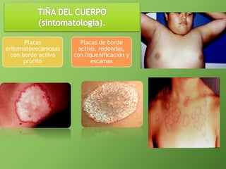 Placas 
eritematoescamosas 
con borde activo 
prúrito 
Placas de borde 
activo, redondas, 
con liquenificación y 
escamas 
 