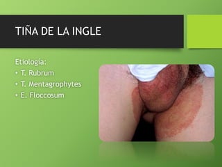 TIÑA DE LA INGLE 
Etiología: 
• T. Rubrum 
• T. Mentagrophytes 
• E. Floccosum 
 