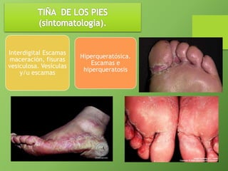 Interdigital Escamas 
maceración, fisuras 
vesiculosa. Vesículas 
y/u escamas 
Hiperqueratósica. 
Escamas e 
hiperqueratosis 
 