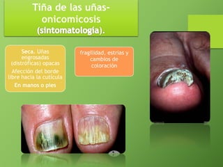 Tiña de las uñas-onicomicosis 
Seca. Uñas 
engrosadas 
(distróficas) opacas 
Afección del borde 
libre hacia la cutícula 
En manos o pies 
fragilidad, estrias y 
cambios de 
coloración 
 