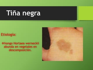Tiña negra 
Etiología: 
hongo Hortaea werneckii 
abunda en vegetales en 
descomposición. 
 