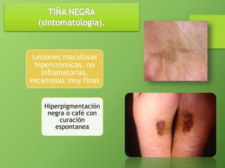 Lesiones maculosas 
hipercrómicas, no 
inflamatorias, 
escamosas muy finas 
Hiperpigmentación 
negra o café con 
curación 
espontanea 
 