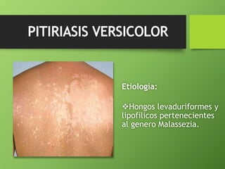 Etiología: 
Hongos levaduriformes y 
lipofilicos pertenecientes 
al genero Malassezia. 
 