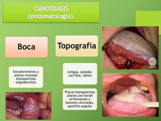Topografía 
Lengua, paladar, 
carrillos, labios 
Placas blanquecinas 
planas con borde 
eritematoso y 
lesiones ulceradas, 
queilitis angular 
Boca 
Enrojecimiento y 
placas mucosas 
blanquecinas 
(algodoncillo) 
 