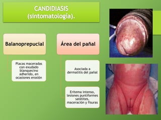 Balanoprepucial 
Placas maceradas 
con exudado 
blanquecino 
adherido, en 
ocasiones erosión 
Área del pañal 
Asociada a 
dermatitis del pañal 
Eritema intenso, 
lesiones puntiformes 
satélites, 
maceración y fisuras 
 