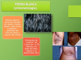 Nódulos blanco-grisaceos 
blandos 
en cabello, barba, 
bigote, vello axilar 
y pubiano , 
debilidad del 
folículo piloso y 
ruptura del mismo 
Formación de 
“collarín” de 
1.5mm de 1 a 10 
nódulos a lo 
largo del pelo, 
rugosos y se 
desprenden fácil 
 
