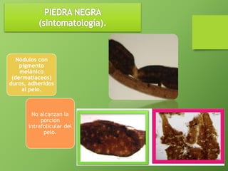 Nódulos con 
pigmento 
melánico 
(dermatiaceos) 
duros, adheridos 
al pelo. 
No alcanzan la 
porción 
intrafolicular del 
pelo. 
 