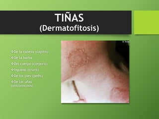 TIÑAS 
(Dermatofitosis) 
De la cabeza (capitis) 
De la barba 
Del cuerpo (corporis) 
Inguinal (cruris) 
De los pies (pedis) 
De las uñas 
(onicomicosis) 
 