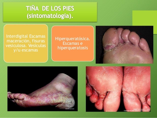 La crema para el hongo las uñas de la mano
