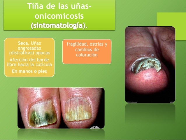 El hongo sobre las palmas de las manos y los pies