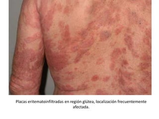 Placas eritematoinfiltradas en región glútea, localización frecuentemente
afectada.
 