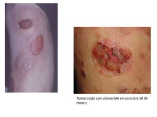 Tumoración con ulceración en cara lateral de
tronco.
 