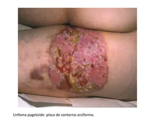 Linfoma pagetoide: placa de contorno arciforme.
 