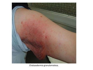 Chalazodermia granulomatosa.
 