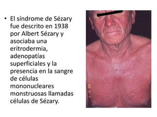 • El síndrome de Sézary
fue descrito en 1938
por Albert Sézary y
asociaba una
eritrodermia,
adenopatías
superficiales y la
presencia en la sangre
de células
mononucleares
monstruosas llamadas
células de Sézary.
 