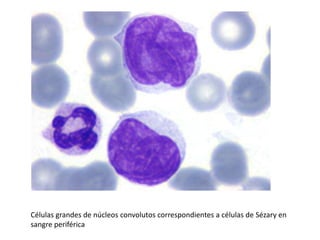 Células grandes de núcleos convolutos correspondientes a células de Sézary en
sangre periférica
 