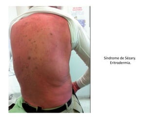 Síndrome de Sézary.
Eritrodermia.
 