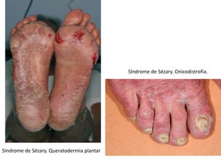 Síndrome de Sézary. Queratodermia plantar
Síndrome de Sézary. Onicodistrofia.
 